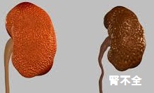 慢性腎臓病 慢性腎臓病